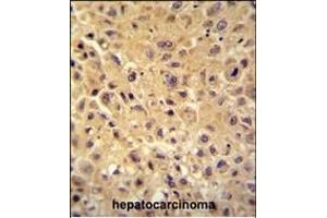 WBSCR27 antibody (N-term) (ABIN654505 and ABIN2844234) immunohistochemistry analysis in formalin fixed and paraffin embedded human hepatocarcinoma followed by peroxidase conjugation of the secondary antibody and DAB staining. (WBSCR27 抗体  (N-Term))