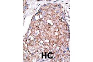Formalin-fixed and paraffin-embedded human hepatocellular carcinoma tissue reacted with SIGLEC7 polyclonal antibody  , which was peroxidase-conjugated to the secondary antibody, followed by AEC staining. (SIGLEC7 抗体  (C-Term))