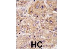 Formalin-fixed and paraffin-embedded human hepatocarcinoma tissue reacted with hUVRAG (C-term), which was peroxidase-conjugated to the secondary antibody, followed by DAB staining. (UVRAG 抗体  (C-Term))