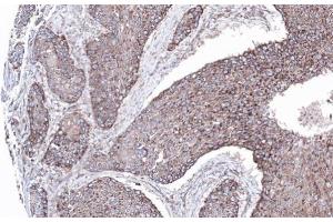 IHC-P Image Immunohistochemical analysis of paraffin-embedded lung SCC xenograft, using MAPK8IP1, antibody at 1:100 dilution. (MAPK8IP1 抗体)