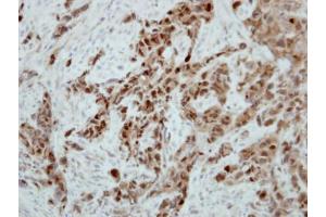 IHC-P Image Immunohistochemical analysis of paraffin-embedded H661 xenograft, using Ataxin 3, antibody at 1:500 dilution. (Ataxin 3 抗体)