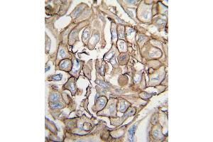 Formalin-fixed and paraffin-embedded human lung carcinoma tissue reacted with HRAS antibody (Center), which was peroxidase-conjugated to the secondary antibody, followed by DAB staining. (HRAS 抗体  (AA 104-128))