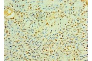 Immunohistochemistry of paraffin-embedded human breast cancer using ABIN7158358 at dilution of 1:100 (LIMK2 抗体  (AA 1-240))