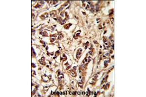 Formalin-fixed and paraffin-embedded human breast carcinoma reacted with PCM-1 Antibody , which was peroxidase-conjugated to the secondary antibody, followed by DAB staining. (PCM1 抗体  (AA 632-661))