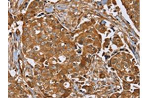 The image on the left is immunohistochemistry of paraffin-embedded Human breast cancer tissue using ABIN7192090(RAB14 Antibody) at dilution 1/40, on the right is treated with synthetic peptide. (RAB14 抗体)