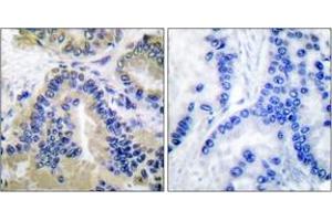 Immunohistochemistry analysis of paraffin-embedded human lung carcinoma tissue, using Caspase 10 Antibody. (Caspase 10 抗体  (AA 430-479))