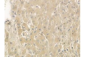 ABIN6265547 and ABIN6276370 at 1/100 staining human hepatocellular carcinoma by IHC-P. (TGFA 抗体  (C-Term))