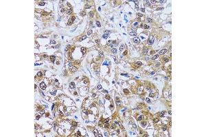 Immunohistochemistry of paraffin-embedded human liver cancer using IMPA1 antibody (ABIN5973786) at dilution of 1/100 (40x lens). (IMPA1 抗体)