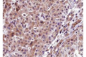 ABIN6277783 at 1/100 staining human liver carcinoma tissue sections by IHC-P. (PERK 抗体  (pThr982))