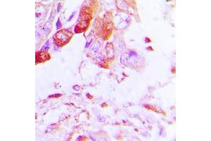 Immunohistochemical analysis of Aquaporin 5 staining in human lung cancer formalin fixed paraffin embedded tissue section. (Aquaporin 5 抗体  (C-Term))