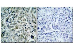 Immunohistochemical analysis of paraffin- embedded human lung carcinoma tissue, using HDAC8 (Ab-39) antibody (E021143). (HDAC8 抗体)