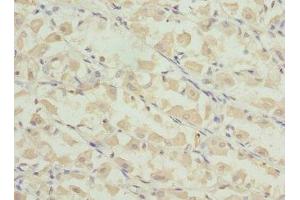 Immunohistochemistry of paraffin-embedded human gastric cancer using ABIN7164276 at dilution of 1:100 (PRICKLE2 抗体  (AA 615-844))