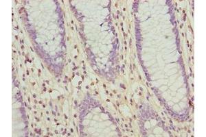Immunohistochemistry of paraffin-embedded human colon cancer using ABIN7176680 at dilution of 1:100 (SLC3A6 (AA 246-461) 抗体)