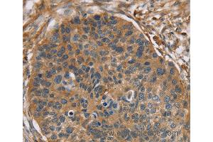 Immunohistochemistry of Human breast cancer using RIPK4 Polyclonal Antibody at dilution of 1:40 (RIPK4 抗体)