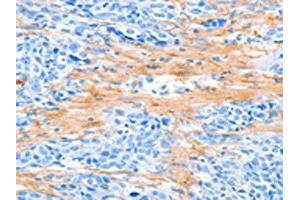 The image on the left is immunohistochemistry of paraffin-embedded Human esophagus cancer tissue using ABIN7189570(AARS Antibody) at dilution 1/50, on the right is treated with synthetic peptide. (AARS 抗体)