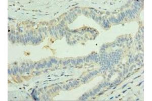 Immunohistochemistry of paraffin-embedded human breast cancer using ABIN7158044 at dilution of 1: 100 (LGI1 抗体  (AA 35-285))