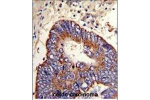 Formalin-fixed and paraffin-embedded human colon carcinoma with P15 Antibody (N-term), which was peroxidase-conjugated to the secondary antibody, followed by DAB staining. (MMP15 抗体  (N-Term))