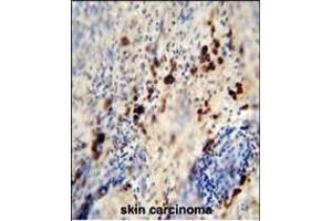 LCE1A antibody (C-term) (ABIN654845 and ABIN2844511) immunohistochemistry analysis in formalin fixed and paraffin embedded human skin carcinoma followed by peroxidase conjugation of the secondary antibody and DAB staining. (LCE1A 抗体  (C-Term))