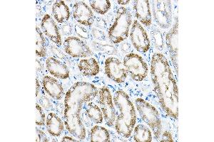 Immunohistochemistry of paraffin-embedded human liver cancer using  Rabbit pAb (ABIN6131168, ABIN6136442, ABIN6136443 and ABIN6224114) at dilution of 1:25 (40x lens). (ACOX1 抗体  (AA 1-270))