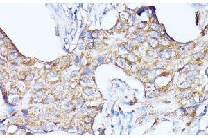 Immunohistochemistry of paraffin-embedded Human breast cancer using CTSF Polyclonal Antibody at dilution of 1:100 (40x lens). (Cathepsin F 抗体)