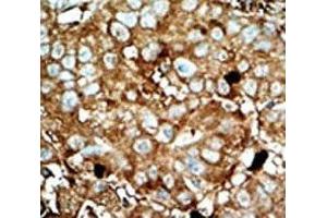 IHC analysis of FFPE human hepatocarcinoma tissue stained with the PFKFB3 antibody (PFKFB3 抗体  (AA 454-484))