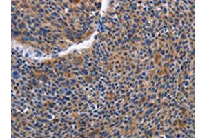 The image on the left is immunohistochemistry of paraffin-embedded Human liver cancer tissue using ABIN7129821(IGSF10 Antibody) at dilution 1/50, on the right is treated with fusion protein. (IGSF1 抗体)