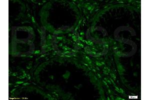 Formalin-fixed and human colon carcinoma tissue labeled with Anti-Phospho-IKK alpha beta (Ser176 Ser180) Polyclonal Antibody, unconjugated (ABIN685183) at 1: 200 followed by incubation with conjugated secondary antibody, Goat Anti-Rabbit IgG, FITC conjugated  , (HIST1H1E 抗体  (pThr18))