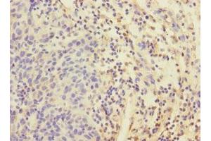 Immunohistochemistry of paraffin-embedded human bladder cancer using ABIN7152192 at dilution of 1:100