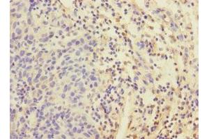 Immunohistochemistry of paraffin-embedded human bladder cancer using ABIN7152192 at dilution of 1:100 (EIF4E2 抗体  (AA 1-240))