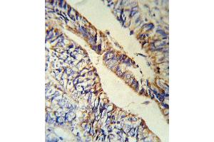 PCSK9 Antibody (C-term) (R) IHC analysis in formalin fixed and paraffin embedded human Colon carcinoma followed by peroxidase conjugation of the secondary antibody and DAB staining.