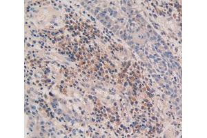IHC-P analysis of skin cancer tissue, with DAB staining. (CASP5 抗体  (AA 145-327))