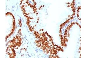 IHC testing of FFPE human prostate carcinoma with FOXA1 antibody. (FOXA1 抗体  (AA 372-472))