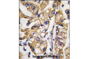 Formalin-fixed and paraffin-embedded human lung carcinoma tissue reacted with HDBP1 Antibody , which was peroxidase-conjugated to the secondary antibody, followed by DAB staining. (SLC2A4RG 抗体  (AA 213-242))