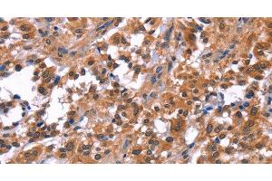 Immunohistochemistry of paraffin-embedded Human thyroid cancer tissue using PIP5K1B Polyclonal Antibody at dilution 1:30 (PIP5K1B 抗体)