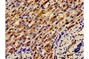 Immunohistochemistry of paraffin-embedded human liver cancer using ABIN7145416 at dilution of 1:100 (APOH 抗体  (AA 119-345))