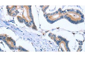 Immunohistochemistry of paraffin-embedded Human colon cancer tissue using FNK Polyclonal Antibody at dilution 1:30 (PLK3 抗体)