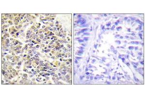 Immunohistochemistry analysis of paraffin-embedded human lung carcinoma tissue using ASC antibody. (STS 抗体  (N-Term))