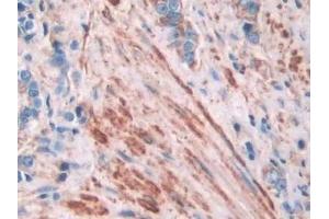 Detection of FLNa in Human Prostate cancer Tissue using Polyclonal Antibody to Filamin A Alpha (FLNa)