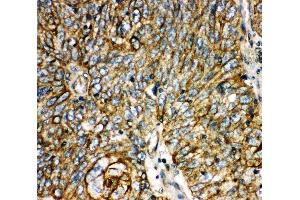 Anti-Aquaporin 6 antibody, IHC(P) IHC(P): Human Lung Cancer Tissue (AQP6 抗体  (C-Term))