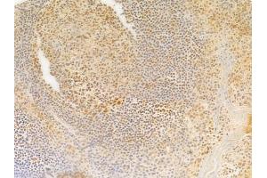 ABIN7095311 and ABIN7099368 at 1/100 staining human tongue carcinoma by IHC-P.