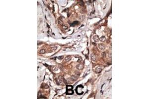 Formalin-fixed and paraffin-embedded human cancer tissue reacted with the primary antibody, which was peroxidase-conjugated to the secondary antibody, followed by DAB staining. (HTRA1 抗体  (C-Term))