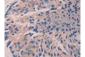 Detection of ITGb1 in Human Prostate cancer Tissue using Polyclonal Antibody to Integrin Beta 1 (ITGb1) (ITGB1 抗体  (AA 140-383))