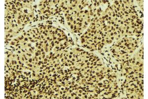 ABIN6274710 at 1/100 staining Human breast cancer tissue by IHC-P.