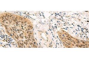 Immunohistochemistry of paraffin-embedded Human esophagus cancer tissue using PSME1 Polyclonal Antibody at dilution of 1:50(x200) (PSME1 抗体)