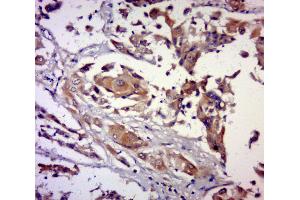 Paraformaldehyde-fixed, paraffin embedded human breast carcinoma, Antigen retrieval by boiling in sodium citrate buffer (pH6. (PRUNE 抗体  (AA 201-300))