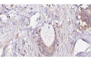 ABIN6273045 at 1/100 staining Human liver cancer tissue by IHC-P. (EXOC1 抗体  (N-Term))