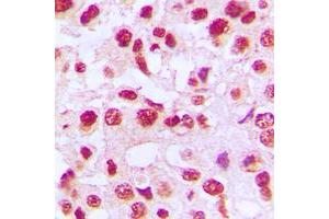 Immunohistochemical analysis of c-Rel staining in human breast cancer formalin fixed paraffin embedded tissue section. (c-Rel 抗体  (C-Term))