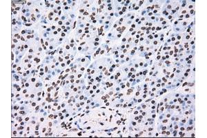 Immunohistochemical staining of paraffin-embedded Adenocarcinoma of colon tissue using anti-TYRO3mouse monoclonal antibody. (TYRO3 抗体)