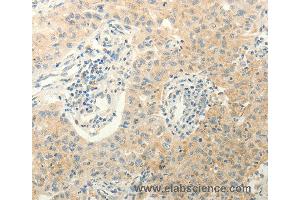 Immunohistochemistry of Human lung cancer using ERG Polyclonal Antibody at dilution of 1:40 (ERG 抗体)