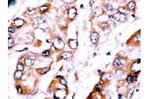 Formalin-fixed and paraffin-embedded human Hepatocellular carcinoma reacted with anti-HDBP2(HDRF-2) Antibody (Center), which was peroxidase-conjugated to the secondary antibody, followed by DAB staining. (ZNF395 抗体  (AA 141-170))